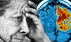 Unutkanlık tek başına alzheimer belirtisi değildir