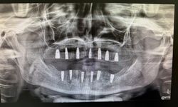 Hiç dişi olmayan hasta implant tedavisiyle yeni dişlerine kavuştu