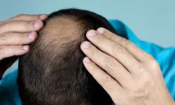 Saçlarınız seyrekse güneşten korunmayı ihmal etmeyin