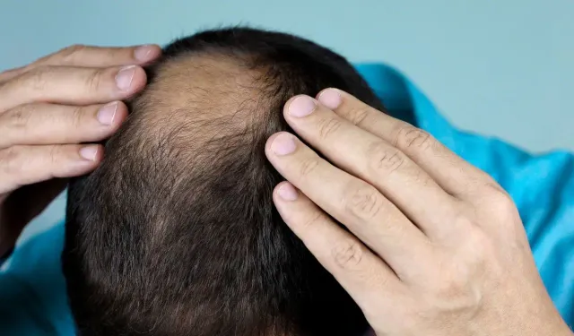 Saçlarınız seyrekse güneşten korunmayı ihmal etmeyin